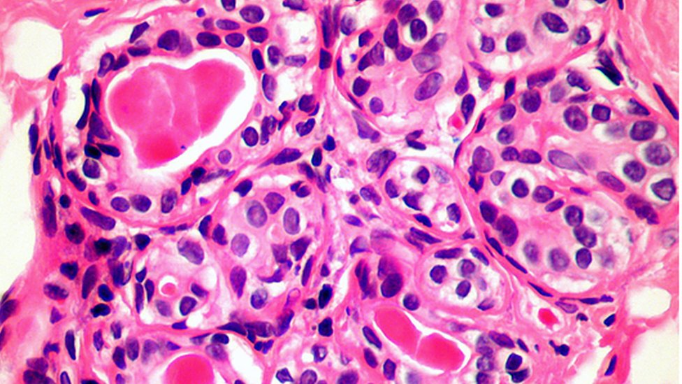 Kanserli meme hücreleri