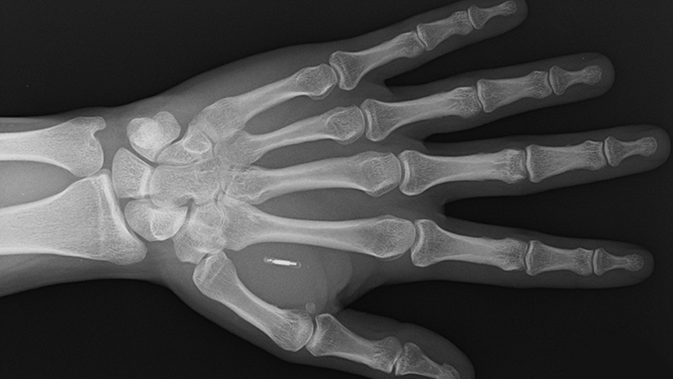 An x-ray showing a Walletmor implant
