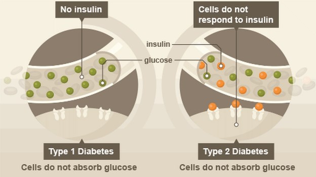 Иллюстрация диабета