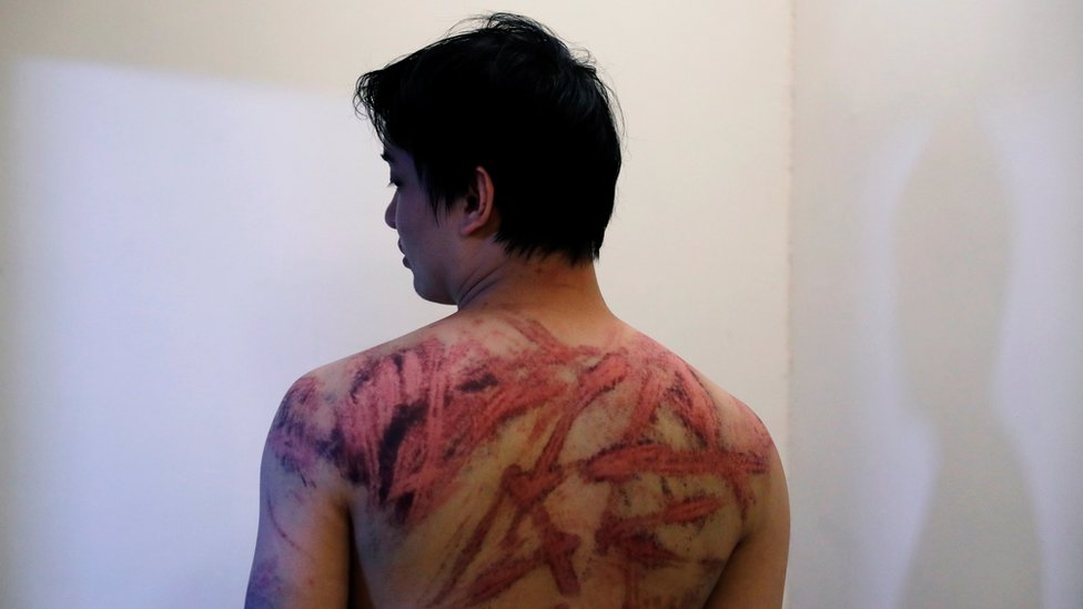 Кальвин Со, жертва нападения на Юэнь Лун в воскресенье, показывает свои раны в больнице в Гонконге, Китай, 22 июля 2019 г.