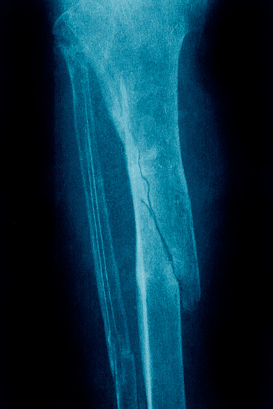 Imagen de Rayos X de una fractura