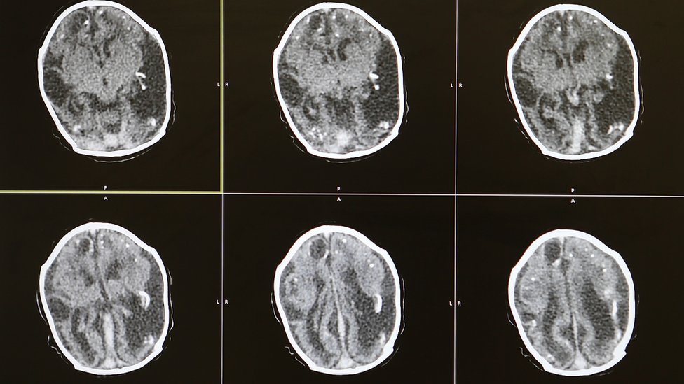 Сканирование мозга 2-месячного ребенка с микроцефалией.