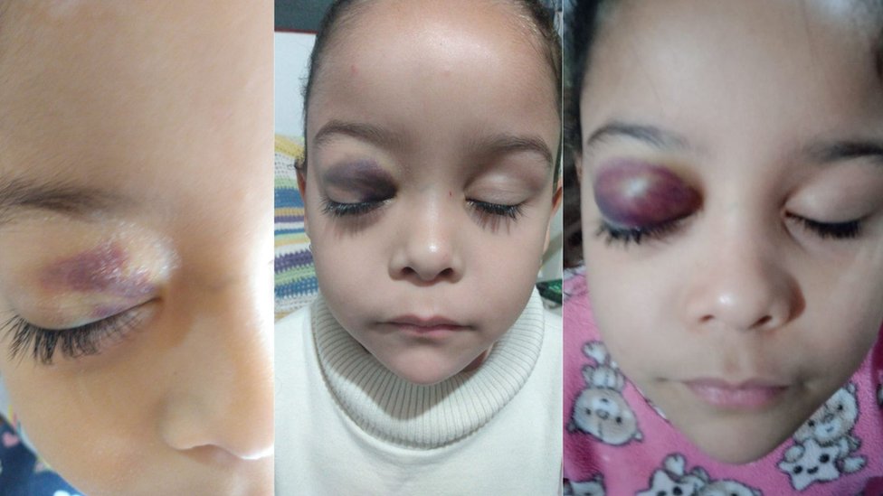 Evolución de la lesión ocular más reciente de Yasmin.