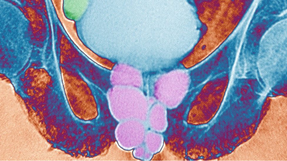 prostatitis csöpög a végéből prostate calcification cause