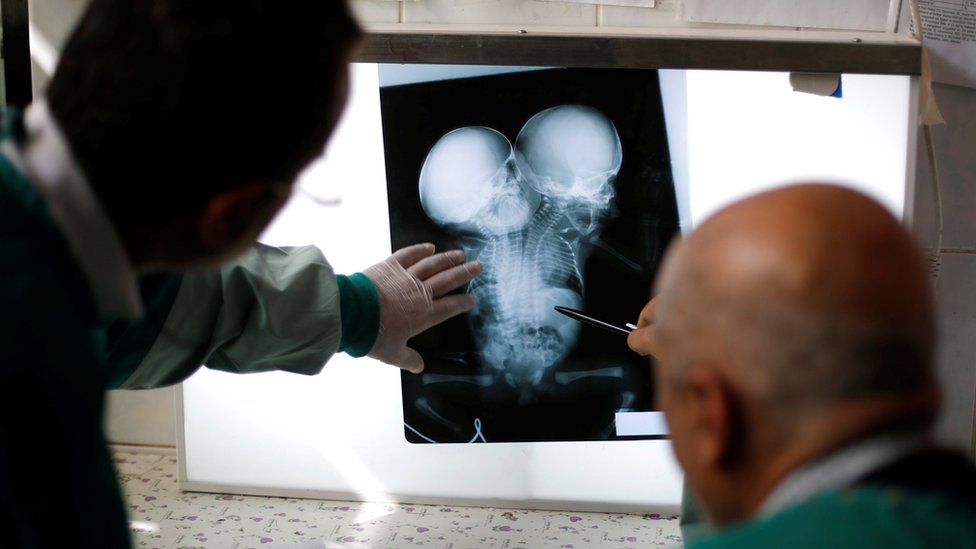 Врачи смотрят на рентгеновский снимок сросшихся мальчиков-близнецов, родившихся в Сане, Йемен (6 февраля 2019 г.)