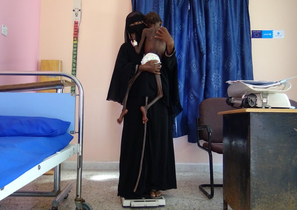 Yemenli Nadia Naharı, yetersiz beslenme nedeniyle yalnızca beş kilo olan beş yaşındaki oğlu Abdelrahman Manash ile birlikte bir klinikte tartılırken