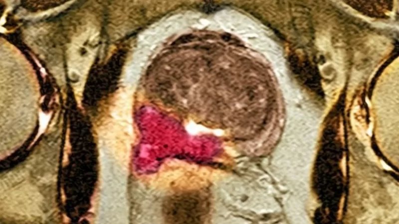 İngiltere'de araştırma: İdrardaki kimi bakteriler agresif prostat kanserinin belirtisi olabilir