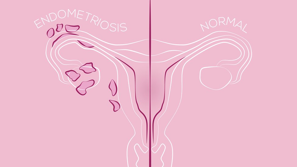 Utero con endometriosis y utero normal