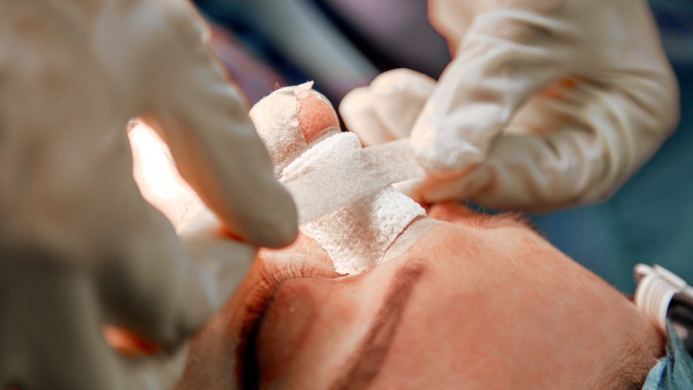 Foto aproximada mostra nariz de paciente, e mãos de profissionais com luva fazendo curativo nele
