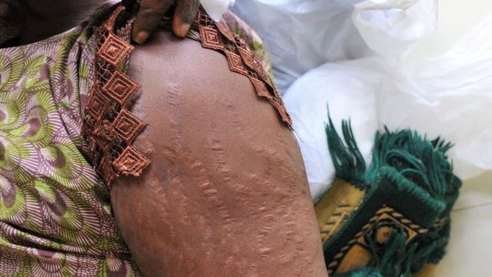 Una mujer muestra las cicatrices en sus brazos en un hospital de Dakar, causadas por tratar de blanquearse la piel
