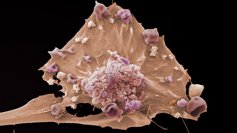 Ćelija raka dojke