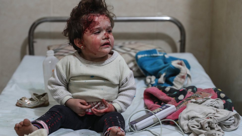 Молодая девушка лечится в больнице после взрыва бомбы в Месрабе, Восточная Гута, Сирия, 3 января 2018 г.