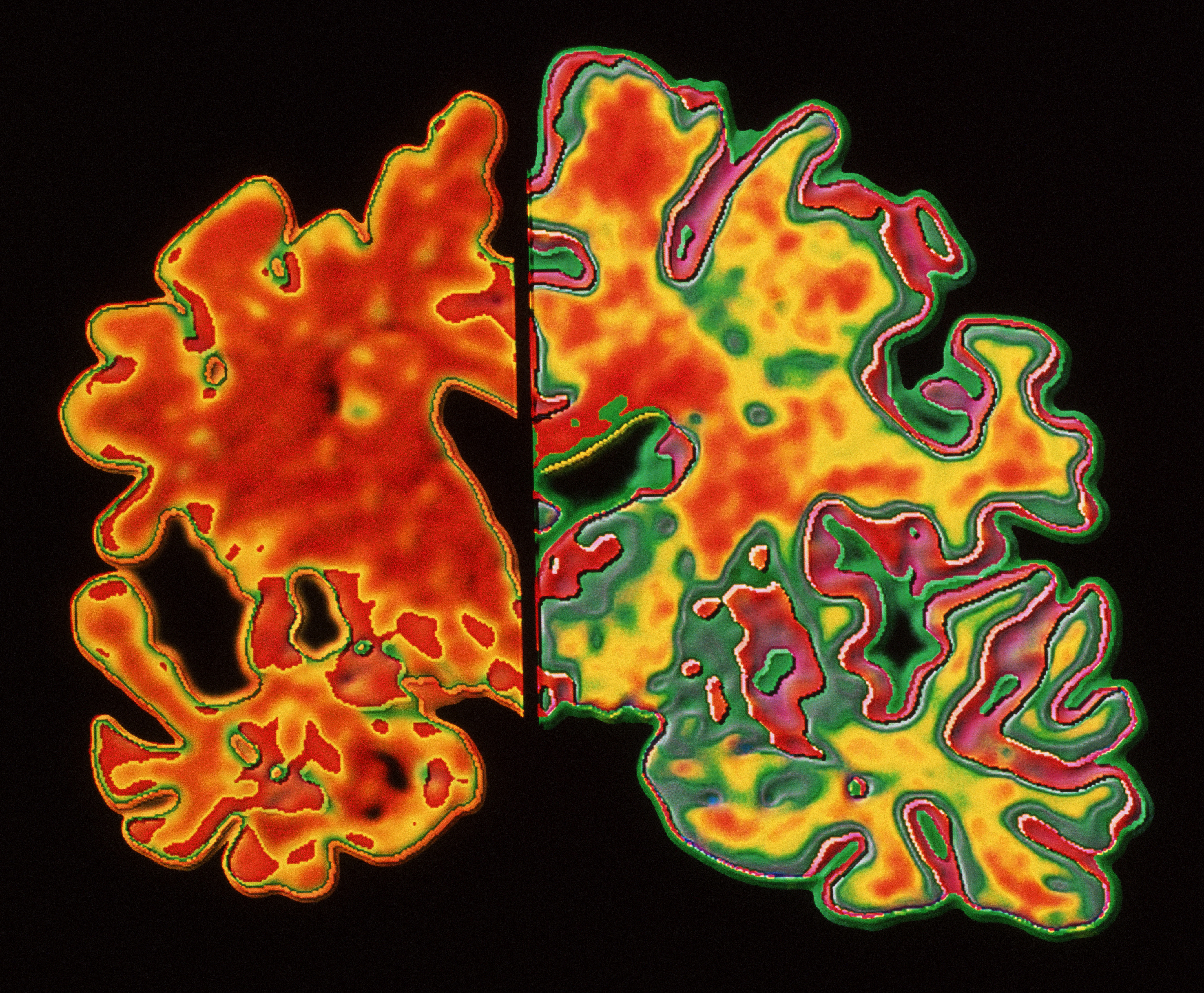 Сравнительные изображения головного мозга пациента с деменцией и пациента без деменции