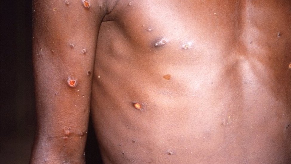 Braços e tronco de um paciente com lesões de pele devido à varíola dos macacos