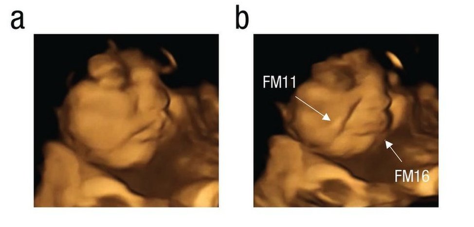 Esta imagen del estudio FETAP (Preferencias de sabor fetal) muestra un feto haciendo muecas a la derecha, como reacción al sabor de la col rizada.