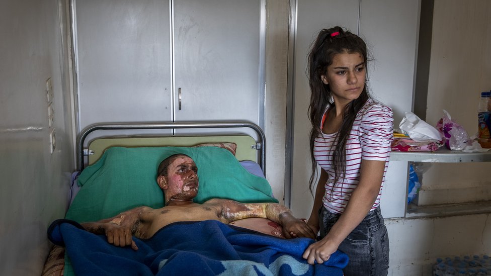 Ahmed Ibrahim, de 18 años y miembro de las Fuerzas Democráticas de Siria, gravemente quemado, recibe la visita de su novia en un hospital en al Hasakah (Siria), el 20 de octubre de 2019. Ahmed Ibrahim, de 18 años y miembro de las Fuerzas Democráticas de Siria, gravemente quemado, recibe la visita de su novia en un hospital en al Hasakah (Siria), el 20 de octubre de 2019.