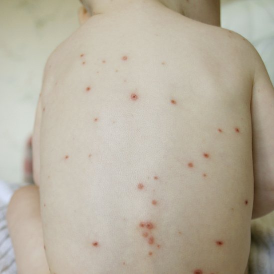 Antivaccine community behind North Carolina chickenpox outbreak BBC News