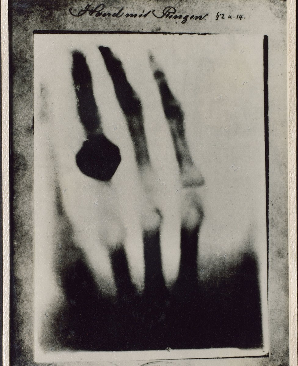 la radiografía de una mano, tomada por Roentgen