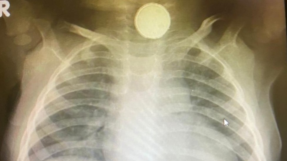 X-ray showing battery in throat