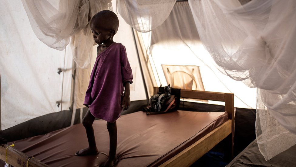 A malnourished child in the town of Tshikapa
