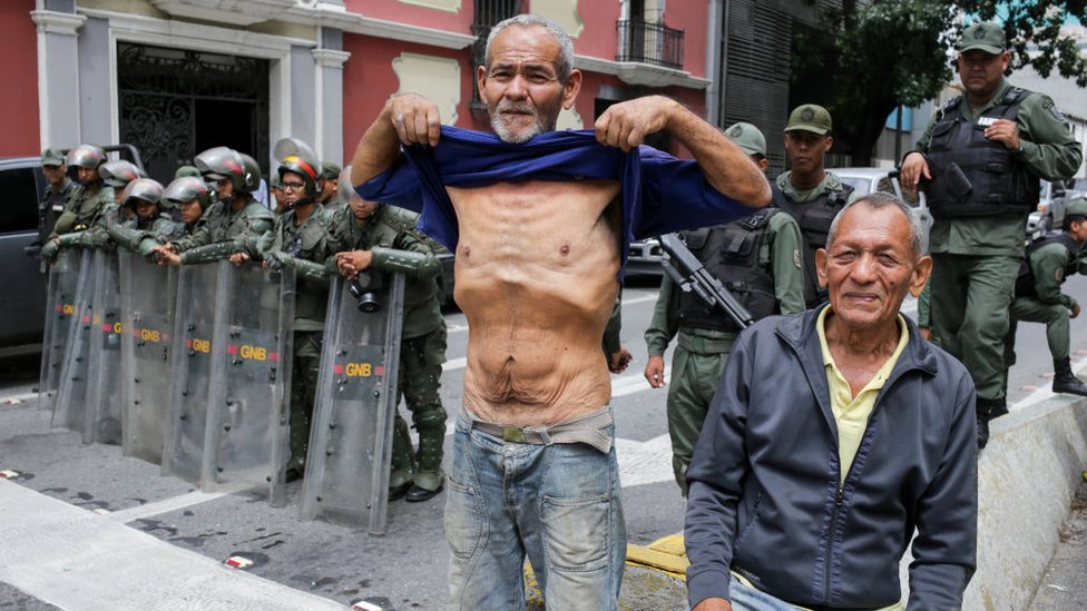 Venezolano mostrando su estado de desnutrición