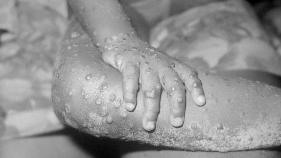 Os braços e pernas de uma menina de 4 anos com varíola dos macacos na Libéria