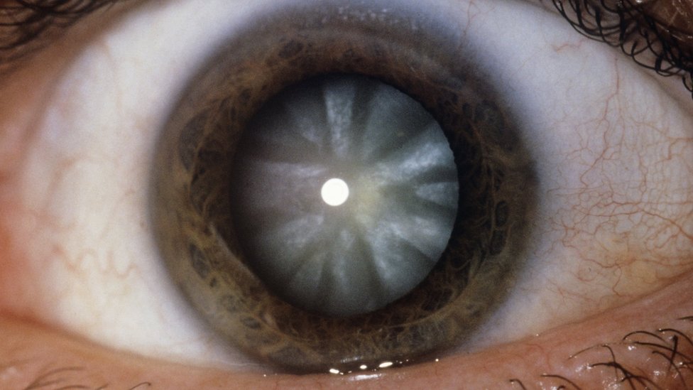 Stunning Operation Regenerates Eye S Lens c News