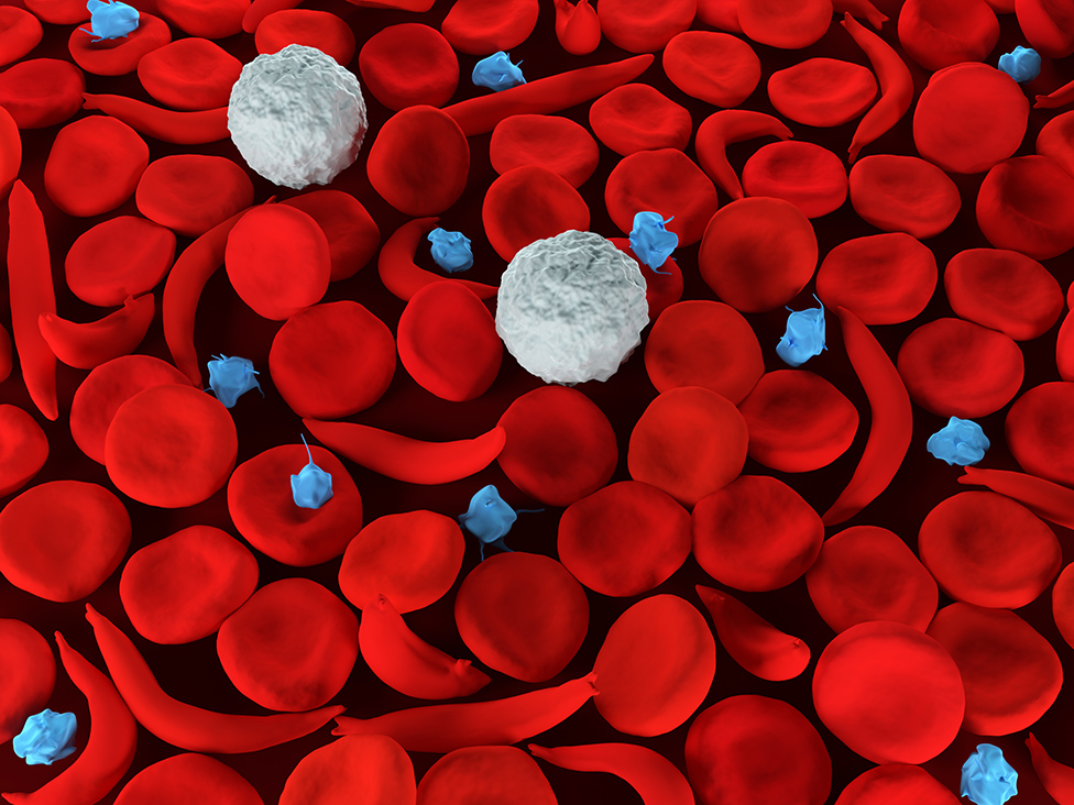 Illustration of sickle red blood cells