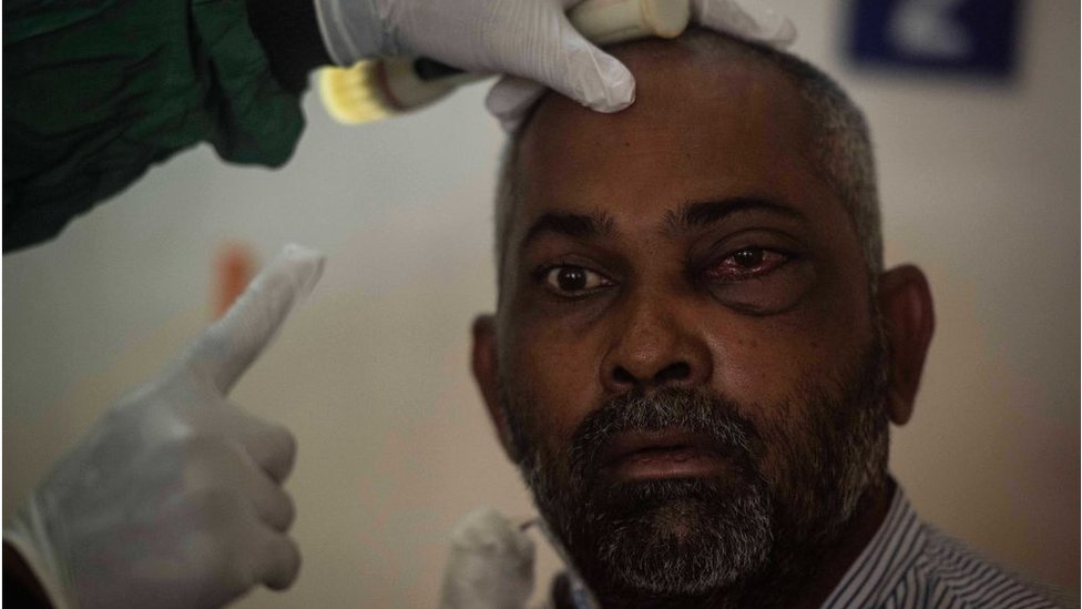 Hindistan'da bir hastanede mukormikoz hastası