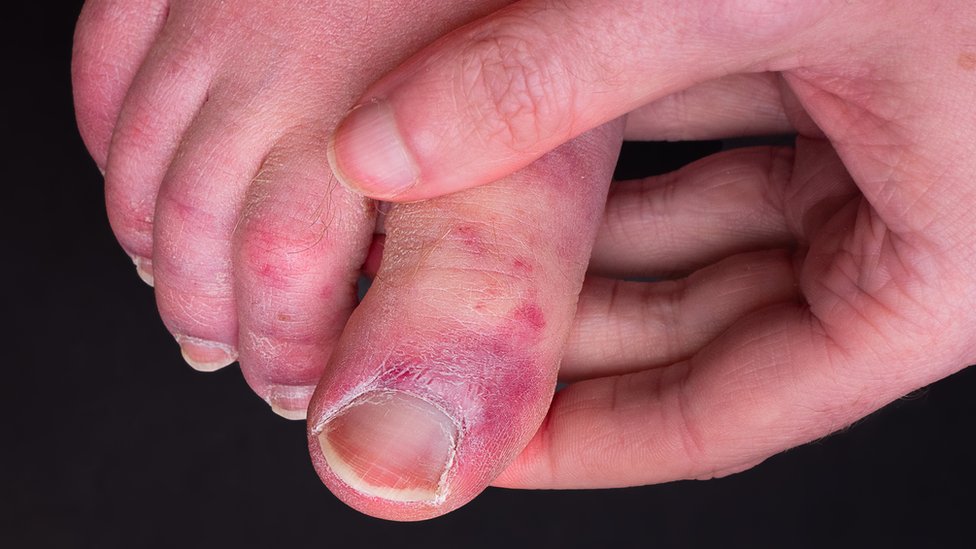 Splinter Hemorrhage Of The Nail High-Res Stock Photo - Getty Images