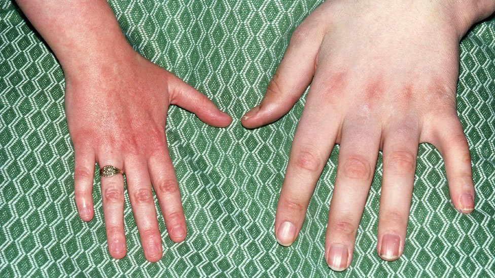   Normal hand (left)) next to someone who suffers from acromegaly (right) 