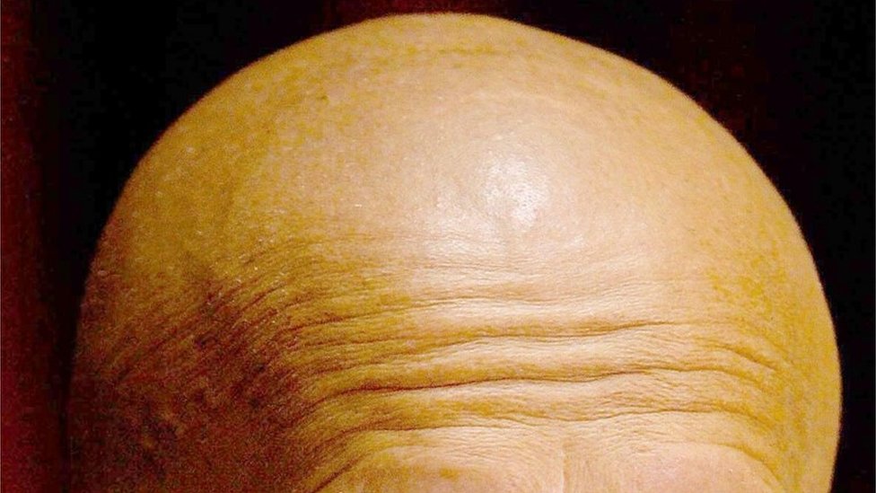 Bald man