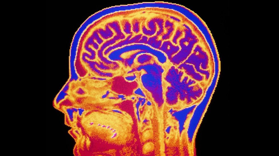 ¿Qué es lo que pasa en nuestro cerebro? Una imagen de escáner de una cabeza