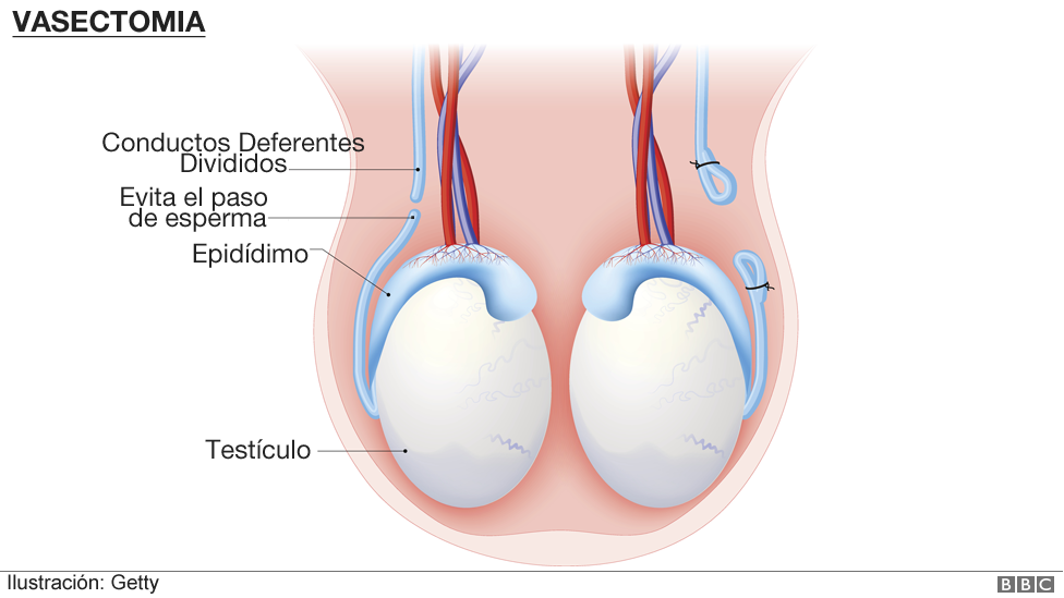 Ilustración de una vasectomía