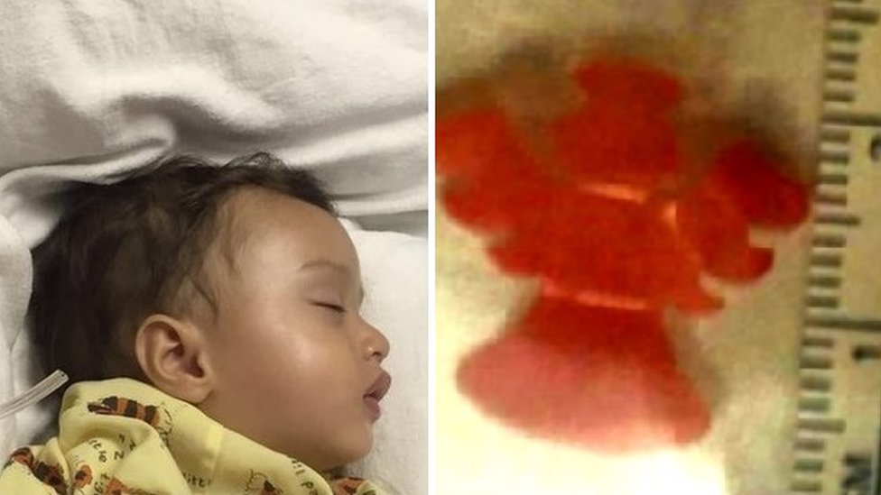 Toy stuck in baby s throat for two weeks BBC News