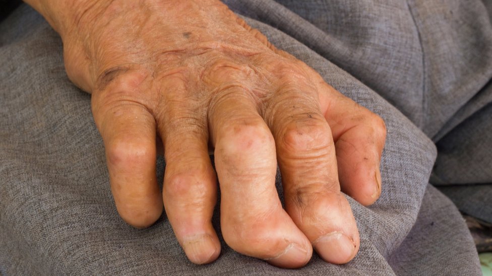 Una mano que sufre los estragos de la lepra