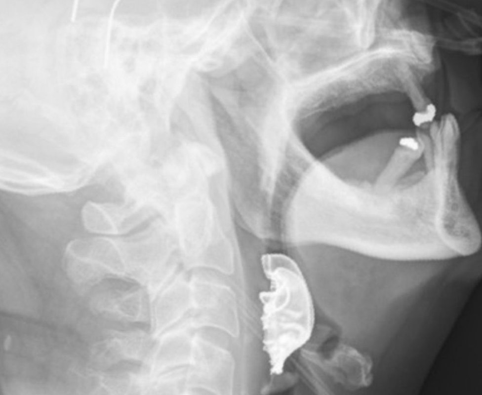 Dentures in throat X-ray