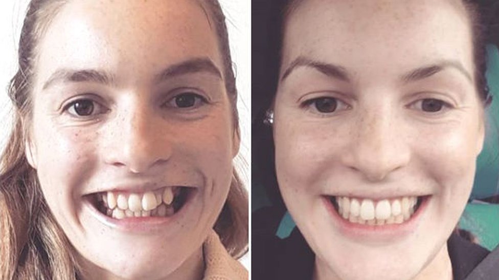 Adult Braces Before And After 