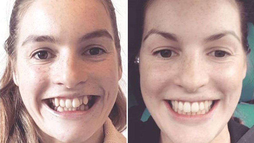 before and after braces adults