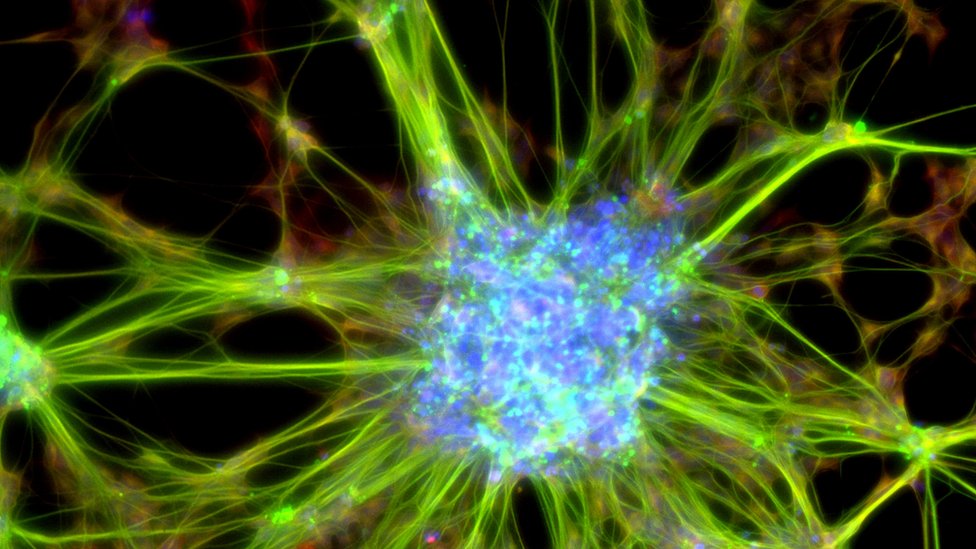 La pobreza puede afectar las conexiones sinápticas en el cerebro. Células cerebrales