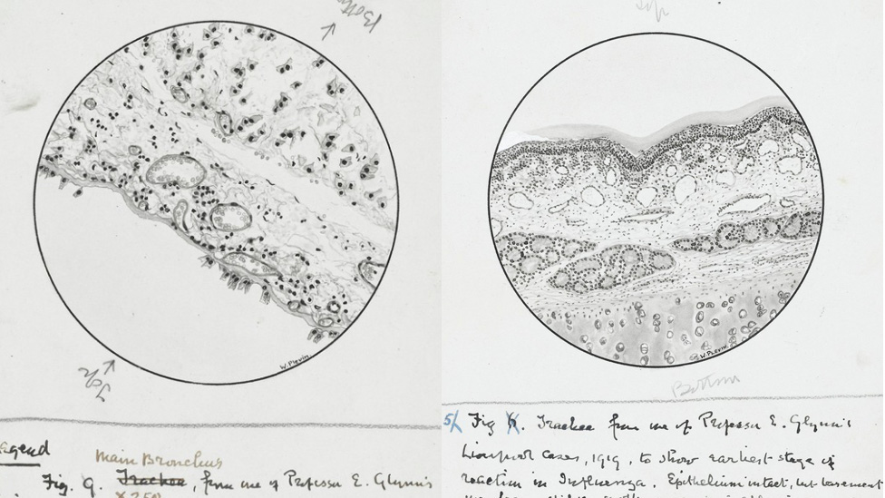 Анатомические рисунки последствий гриппа, 1918 г.