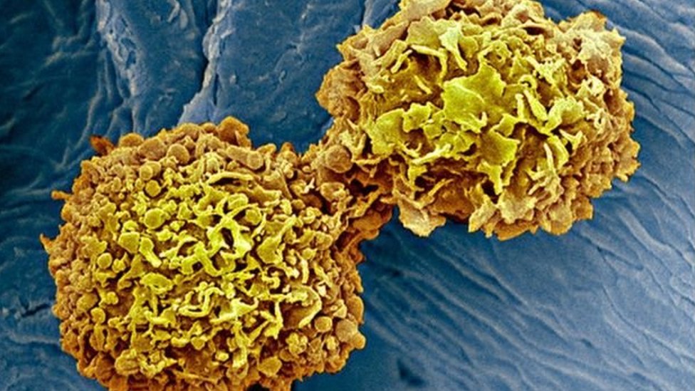 ব্রেস্ট ক্যান্সার বা স্তন ক্যান্সার: কী লক্ষণ দেখে বোঝা যাবে? কীভাবে সাবধান  হবেন? - BBC News বাংলা