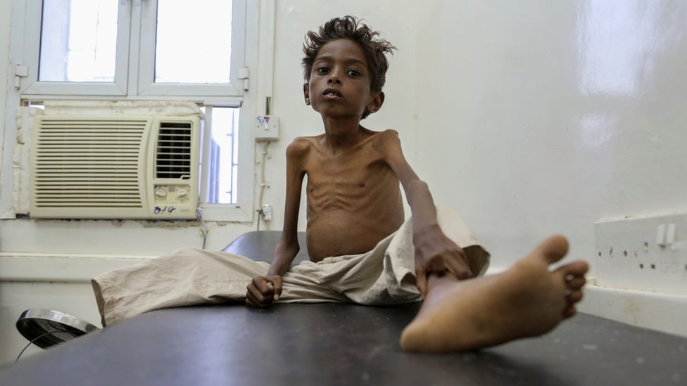 Пятилетний Моханнад Али лежит на больничной койке в Абсе, Йемен