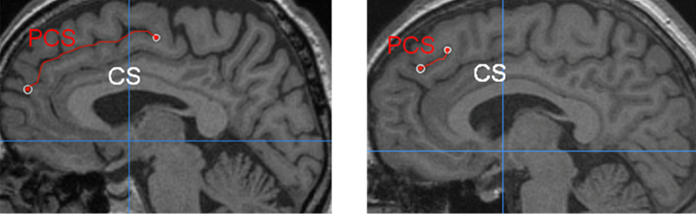 два сканирования мозга, показывающие один длинный и один короткий PCS
