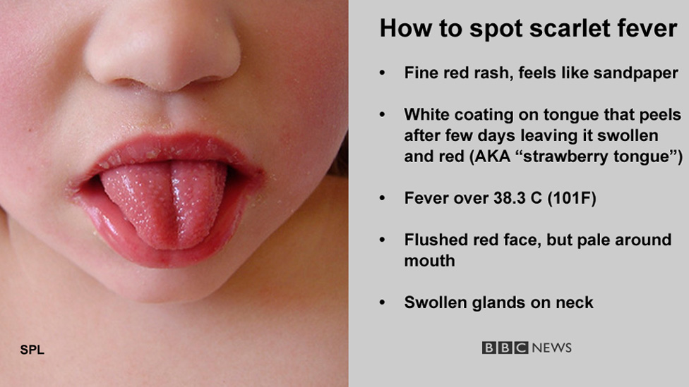 scarlet-fever-cases-hit-50-year-high-in-england-bbc-news