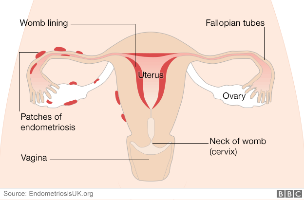 Диаграмма, показывающая, как эндометриоз формируется вокруг маточных труб и яичников