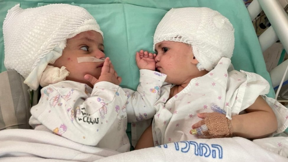 Twins conjoined at head separated after rare surgery in Israel