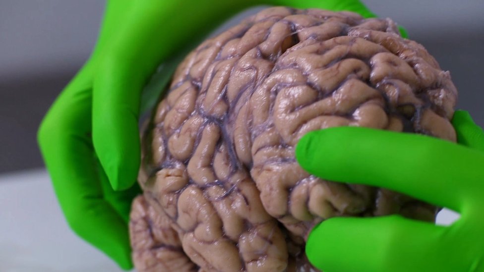 BBC's Fergus Walsh looks at a brain