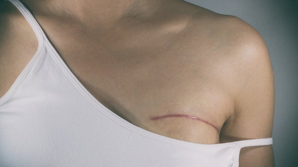 mujer con cicatriz en el pecho