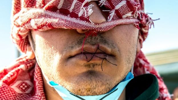 Hombre con los labio cosidos